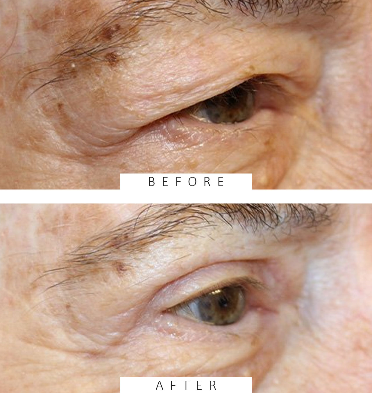 Upper Blepharoplasty