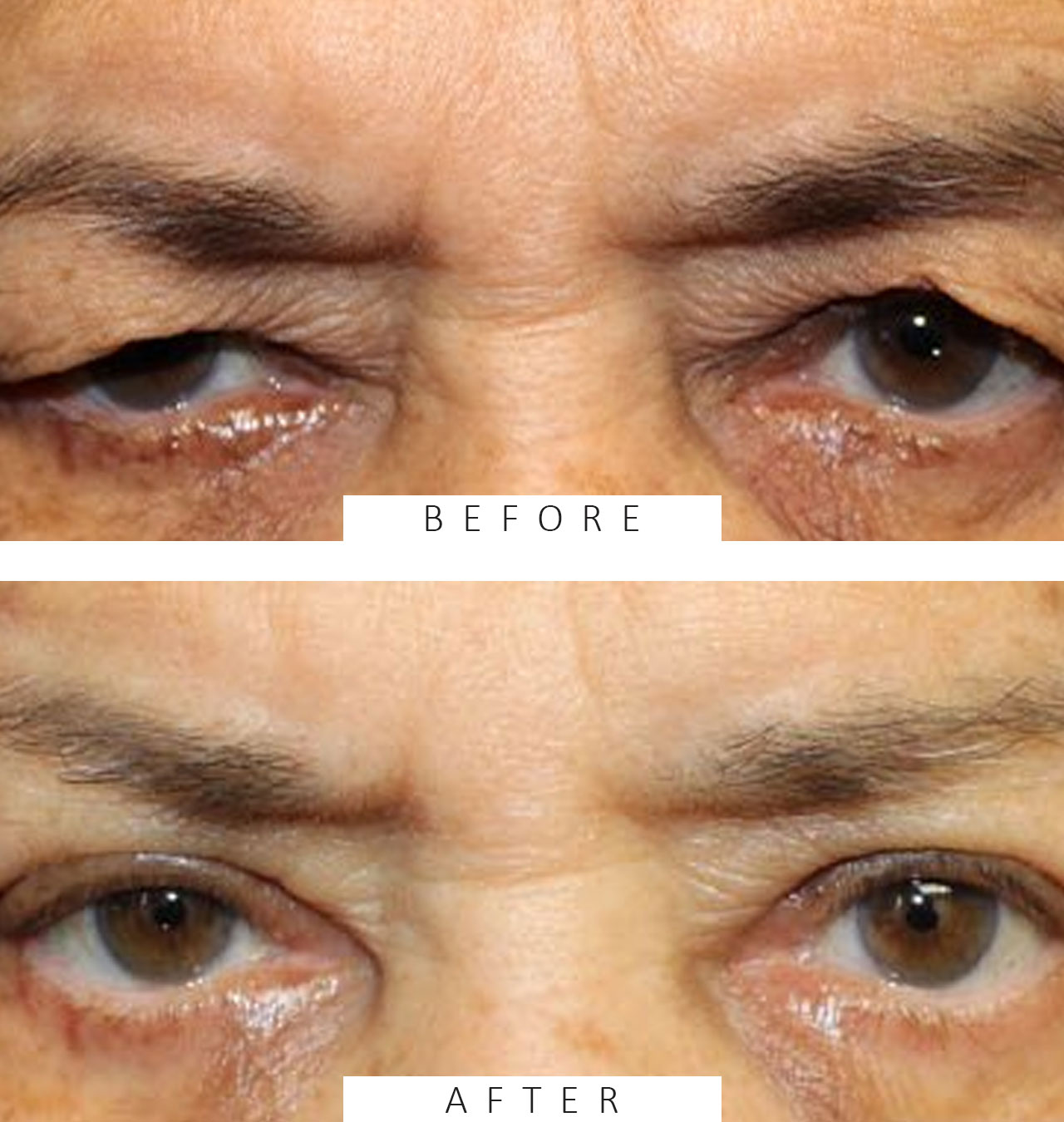 Upper Blepharoplasty & Brow Lift
