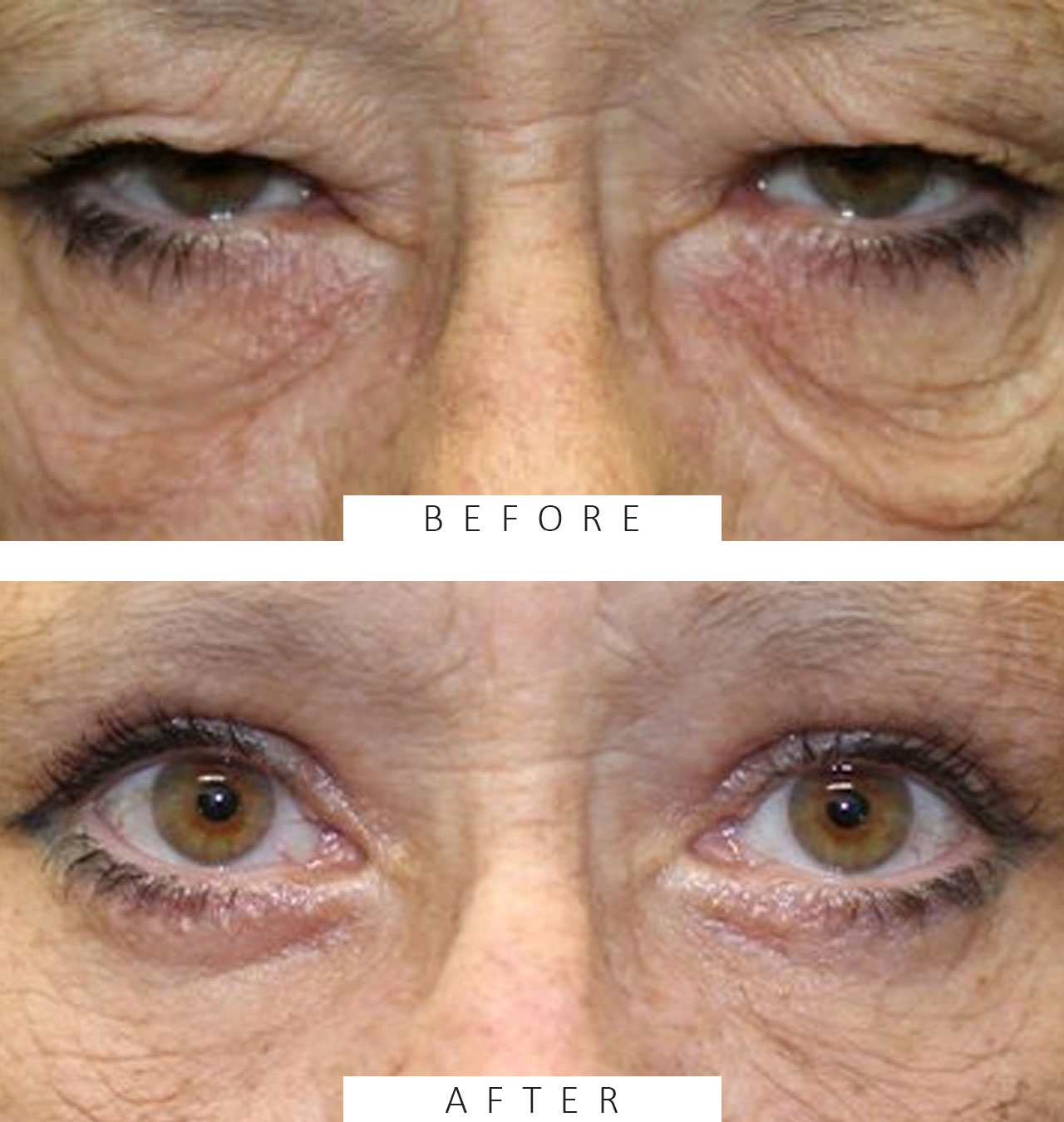 Upper & Lower Blepharoplasty & Direct Brow Ptosis Repair.