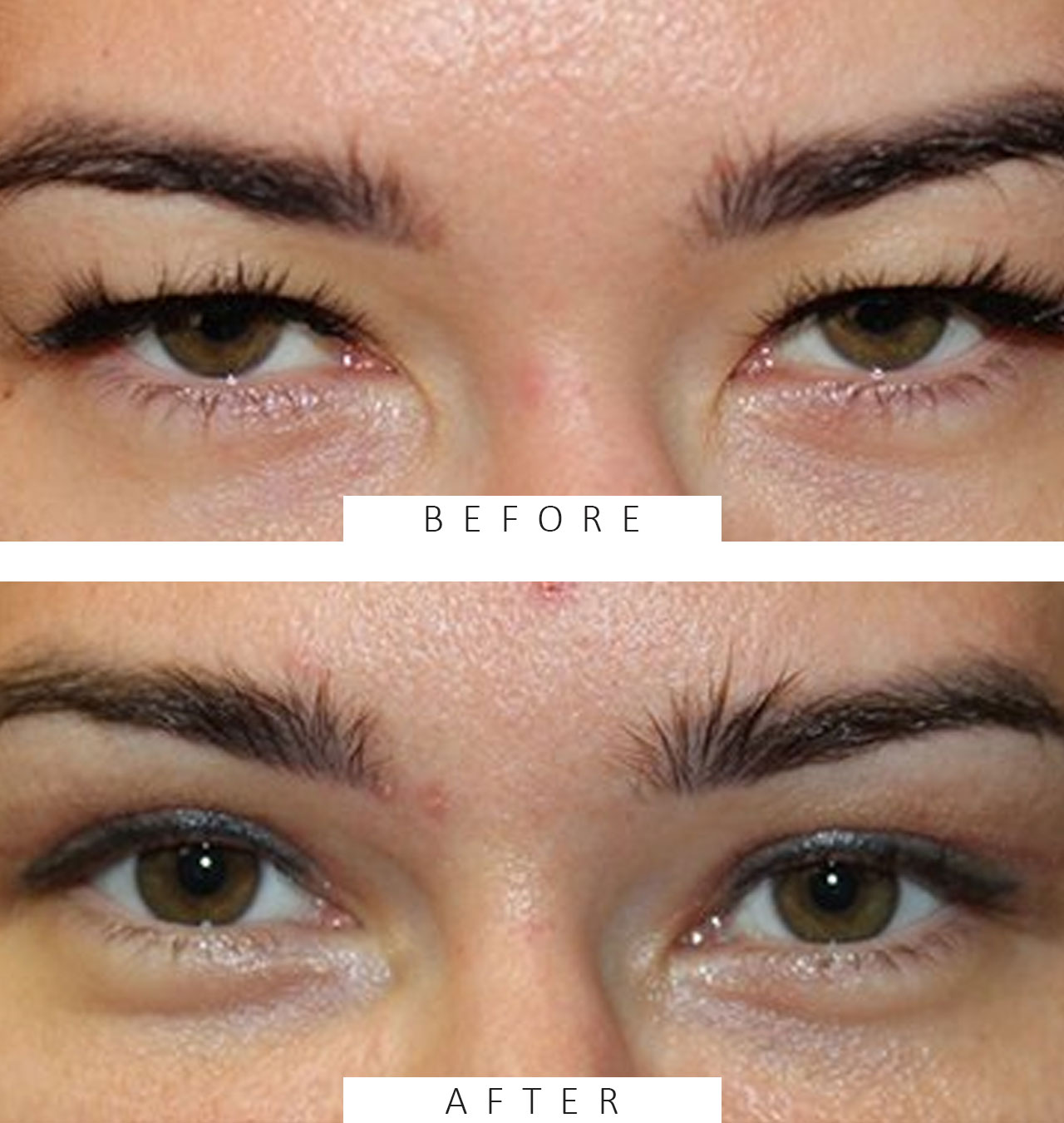 Upper Blepharoplasty