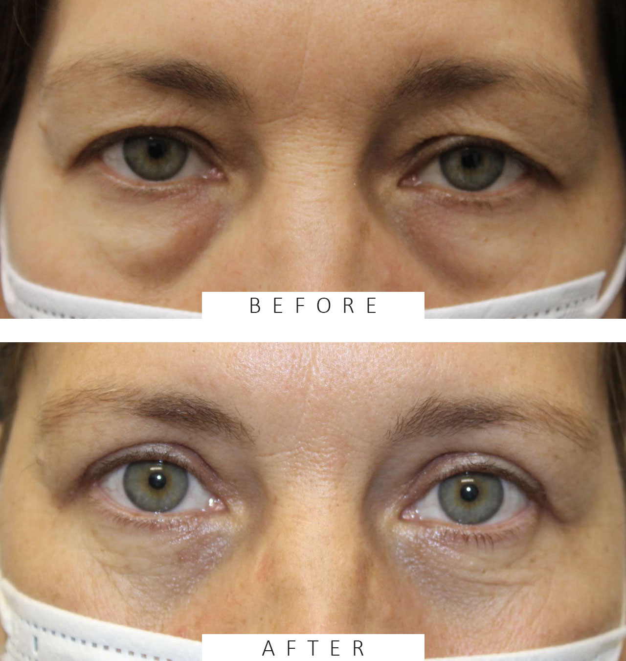 Upper & Lower Blepharoplasty