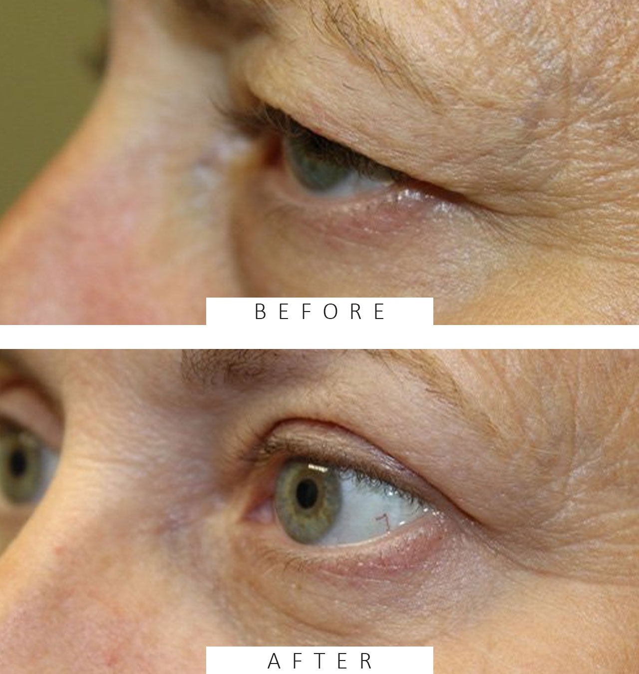 Upper & Lower Eyelid Blepharoplasty