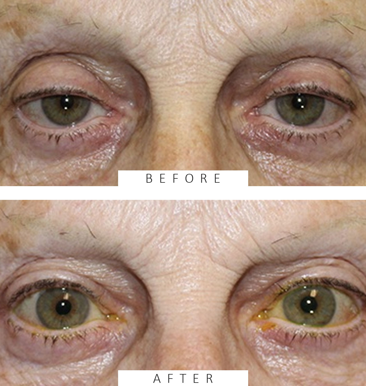 Ptosis repair on upper eyelids.