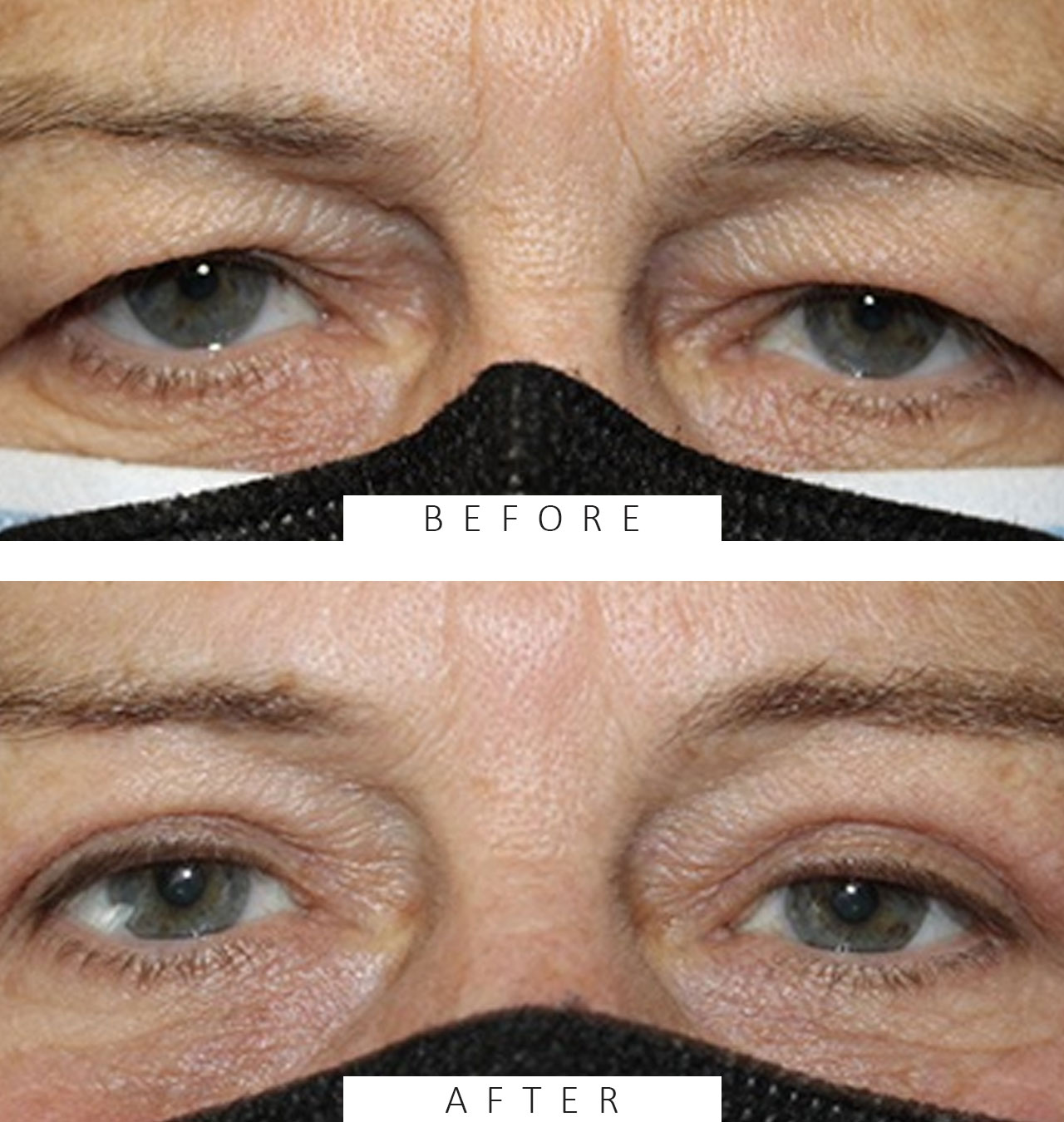Bilateral Upper Blepharoplasty with Temporal Brow Lift