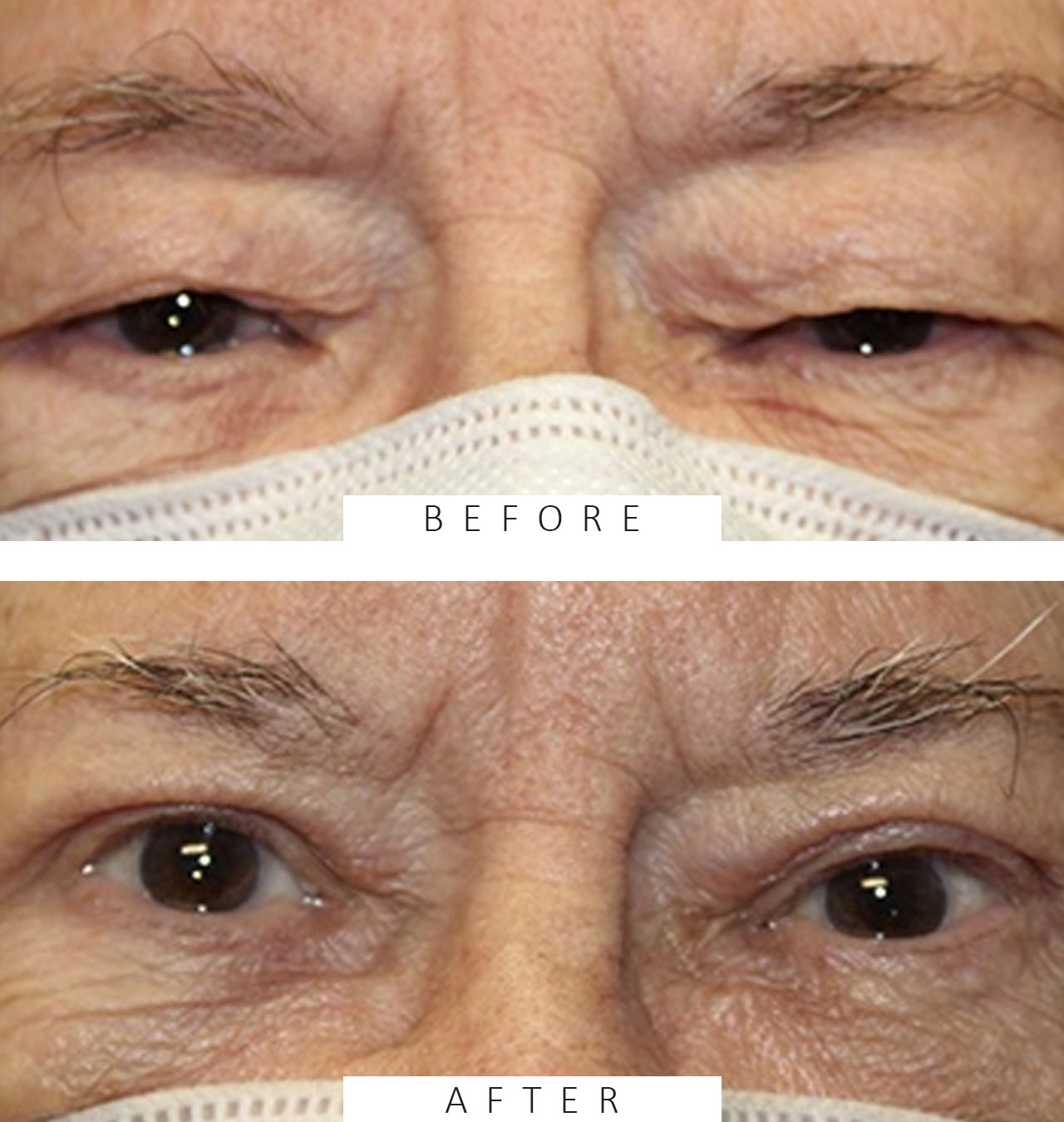 Bilateral Upper Blepharoplasty