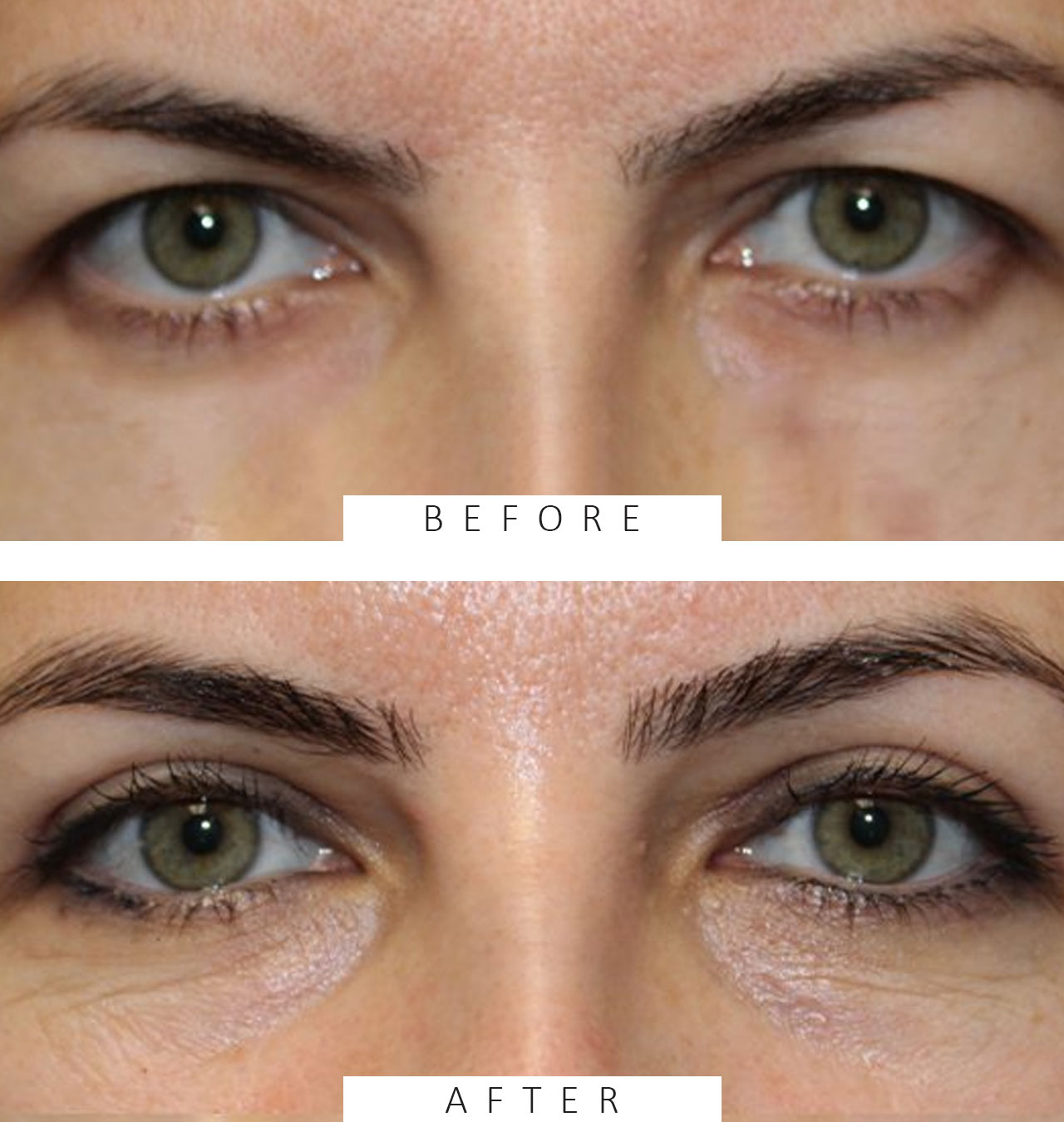 Upper Blepharoplasty