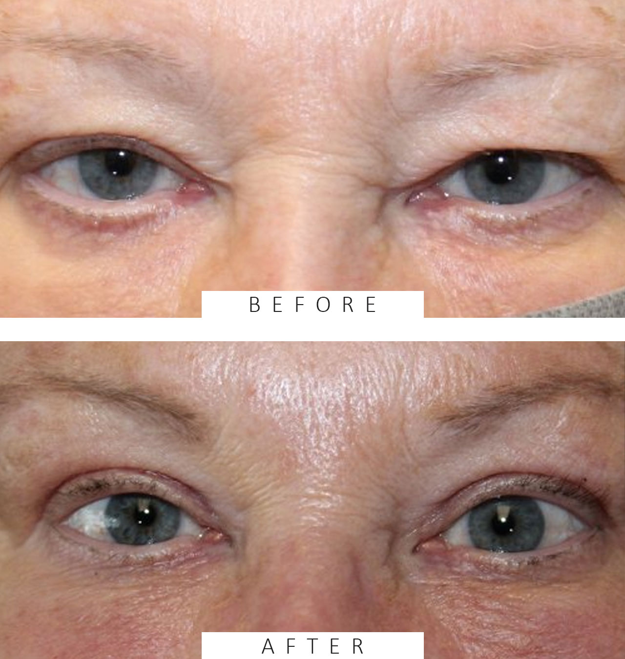 Upper Blepharoplasty