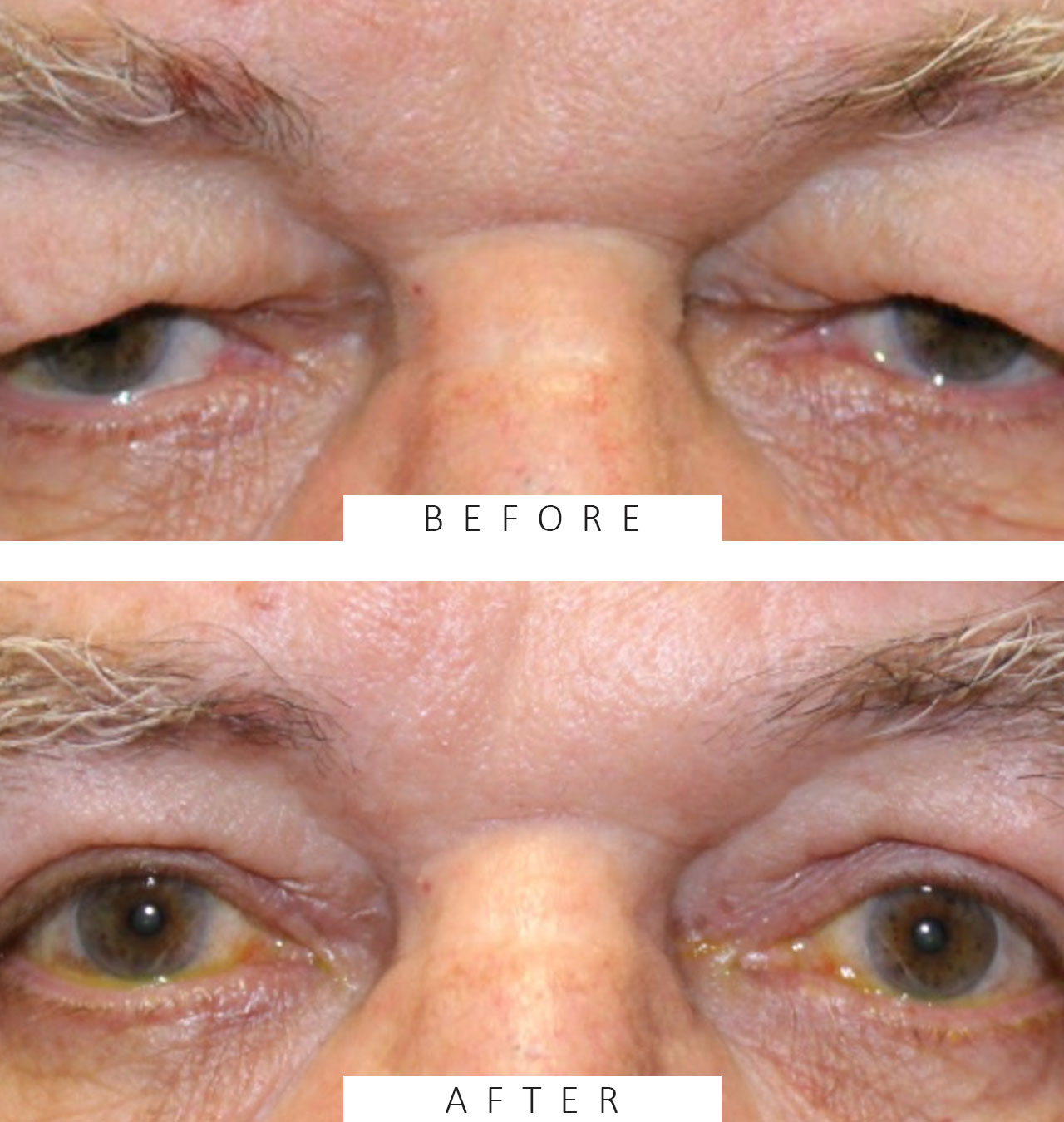 Upper Blepharoplasty