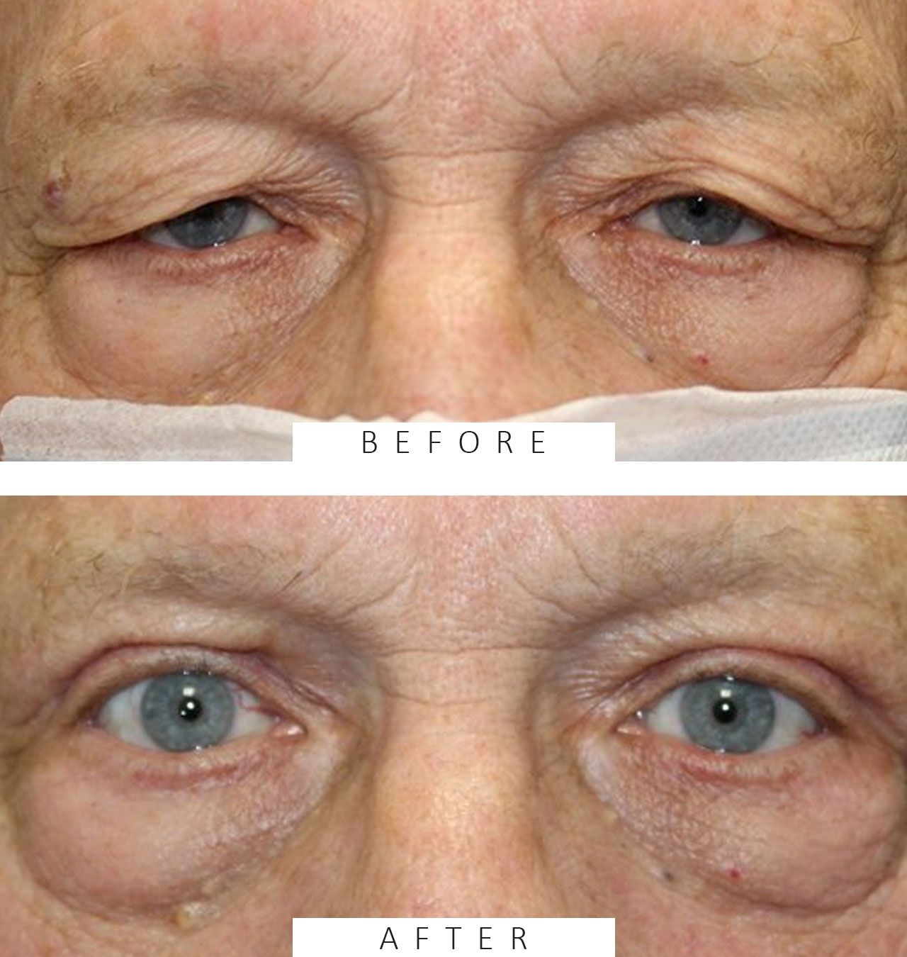 Direct Brow Ptosis Repair and Blepharoplasty