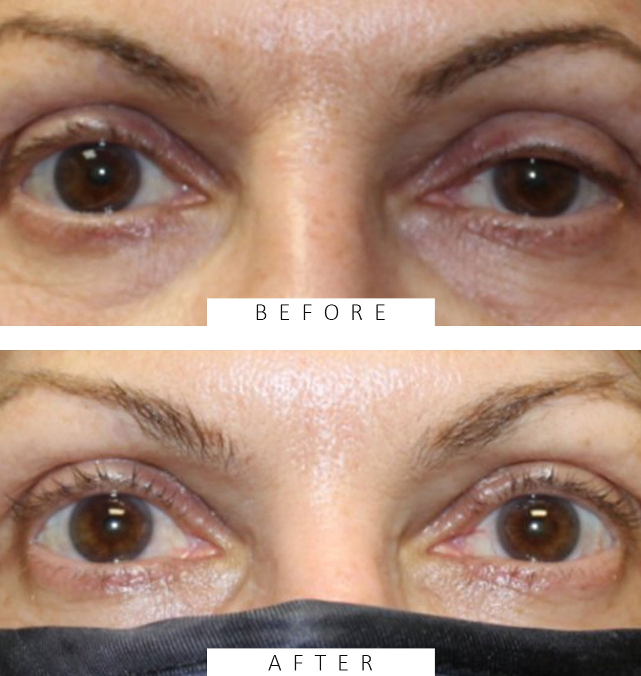 Ptosis repair on upper eyelids.