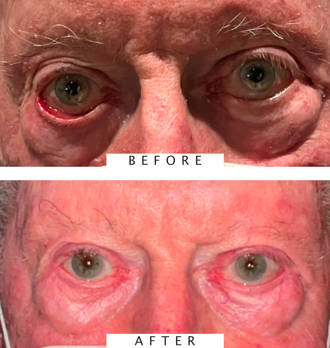 Ectropion Repair