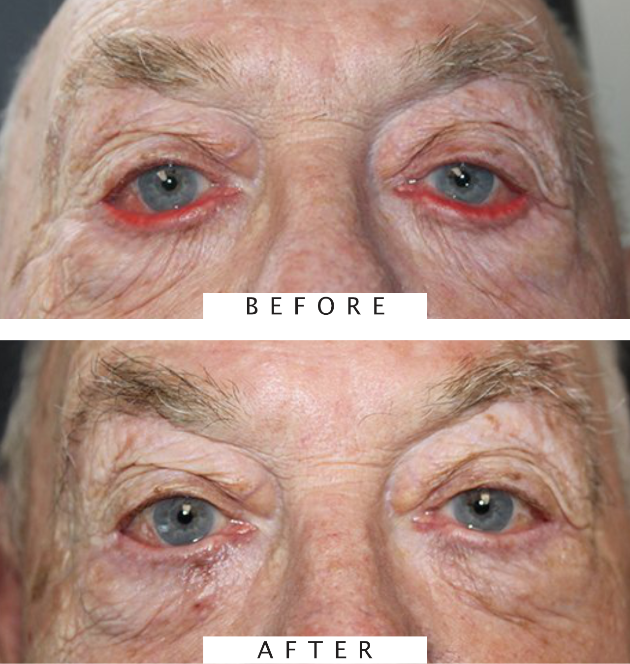 Ectropion Repair