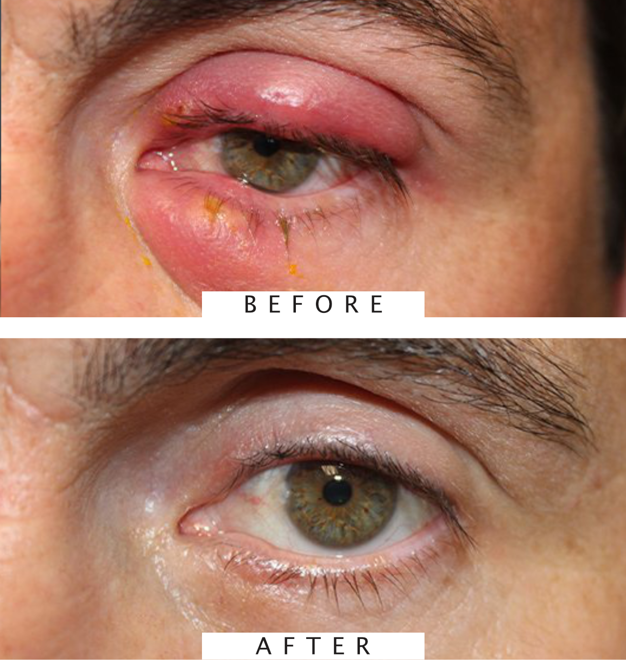 Chalazion Removal Procedure