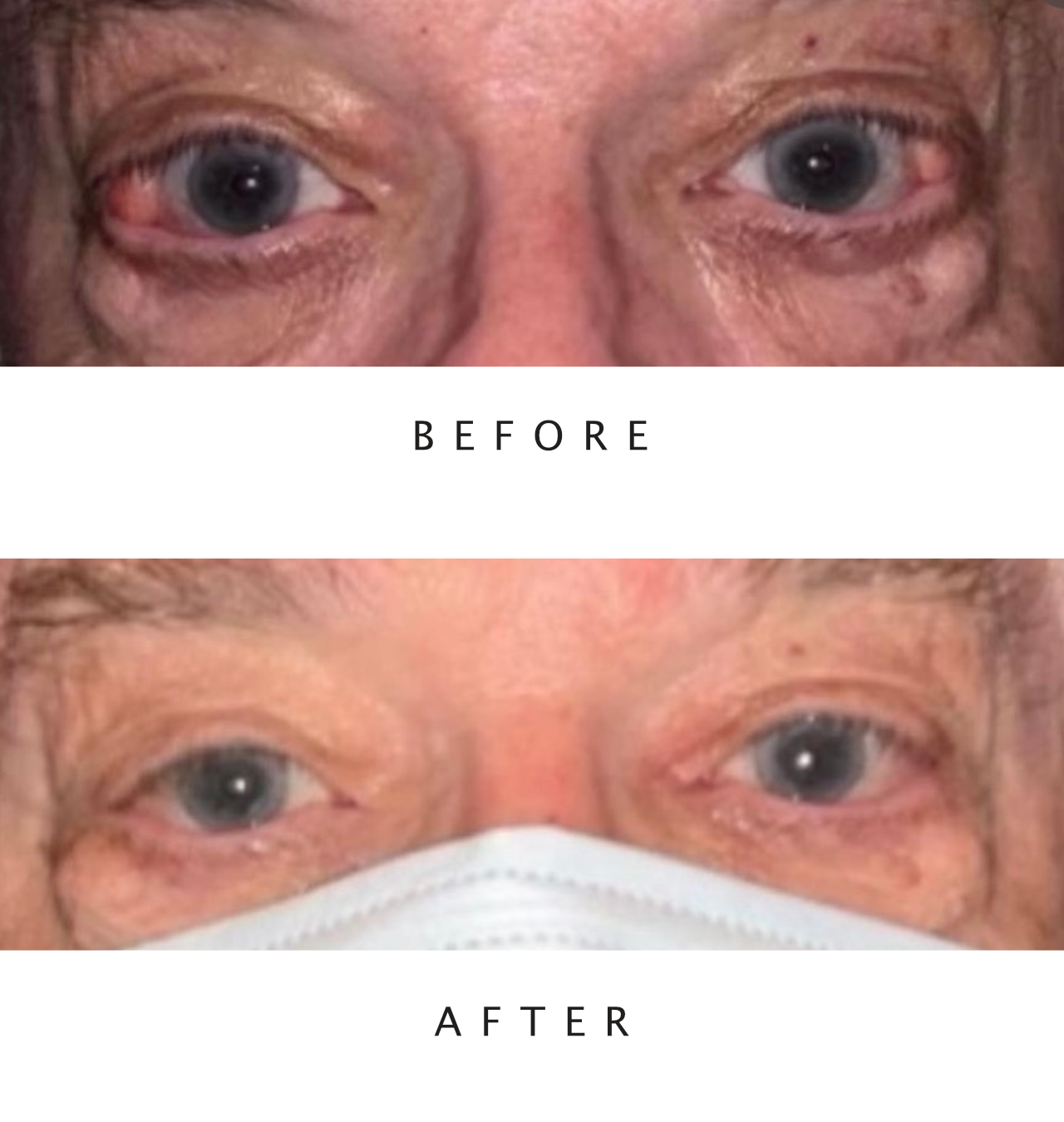 Orbital Fat Removal