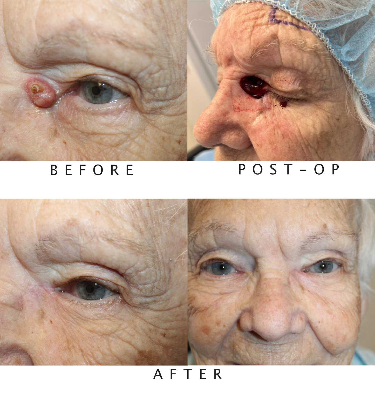 Eyelid Reconstruction After Skin Cancer