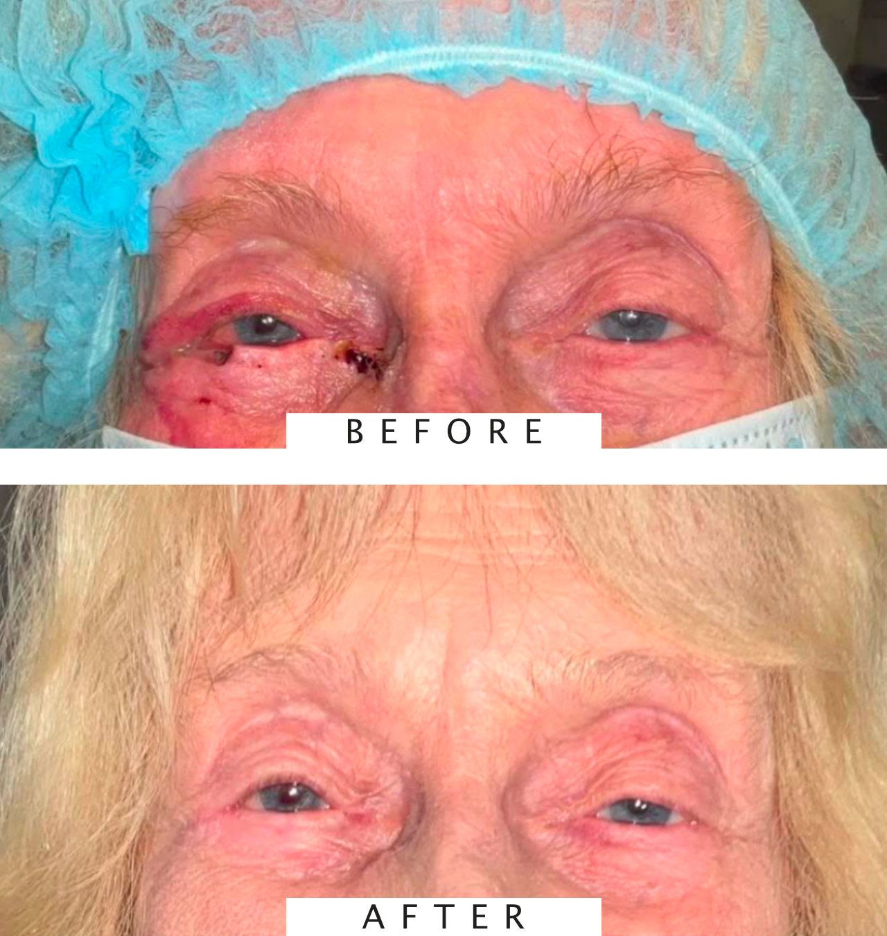 Mohs Surgery for Skin Cancer Reconstruction of Eyelid