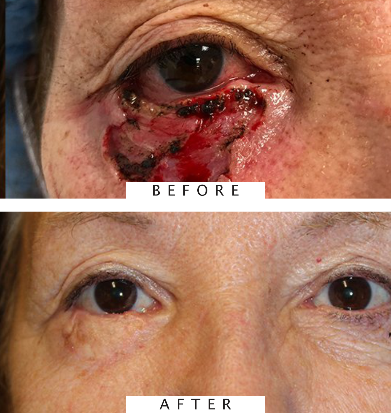 Eyelid Reconstruction After Skin Cancer