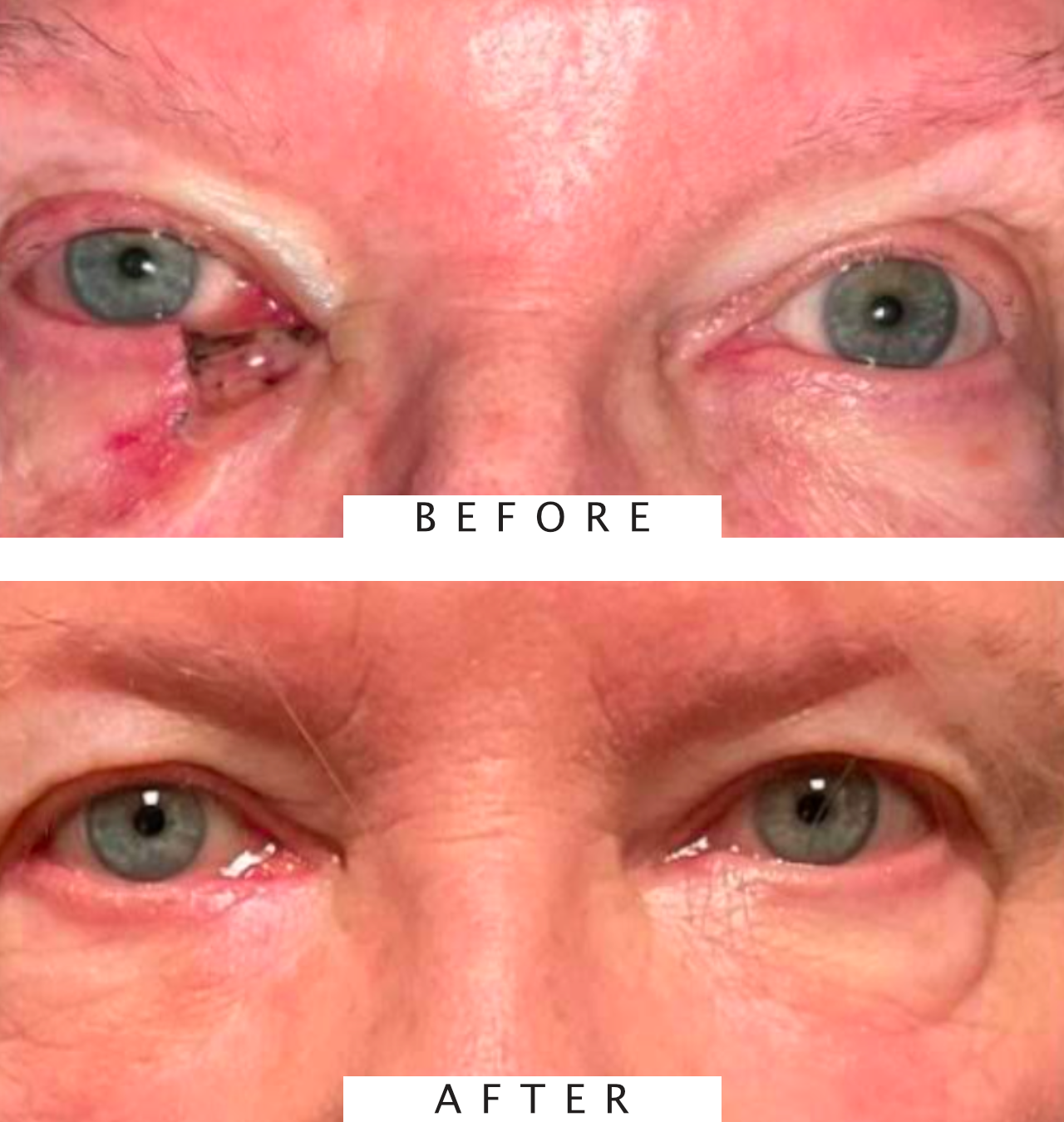 Mohs Surgery for Skin Cancer Reconstruction of Eyelid