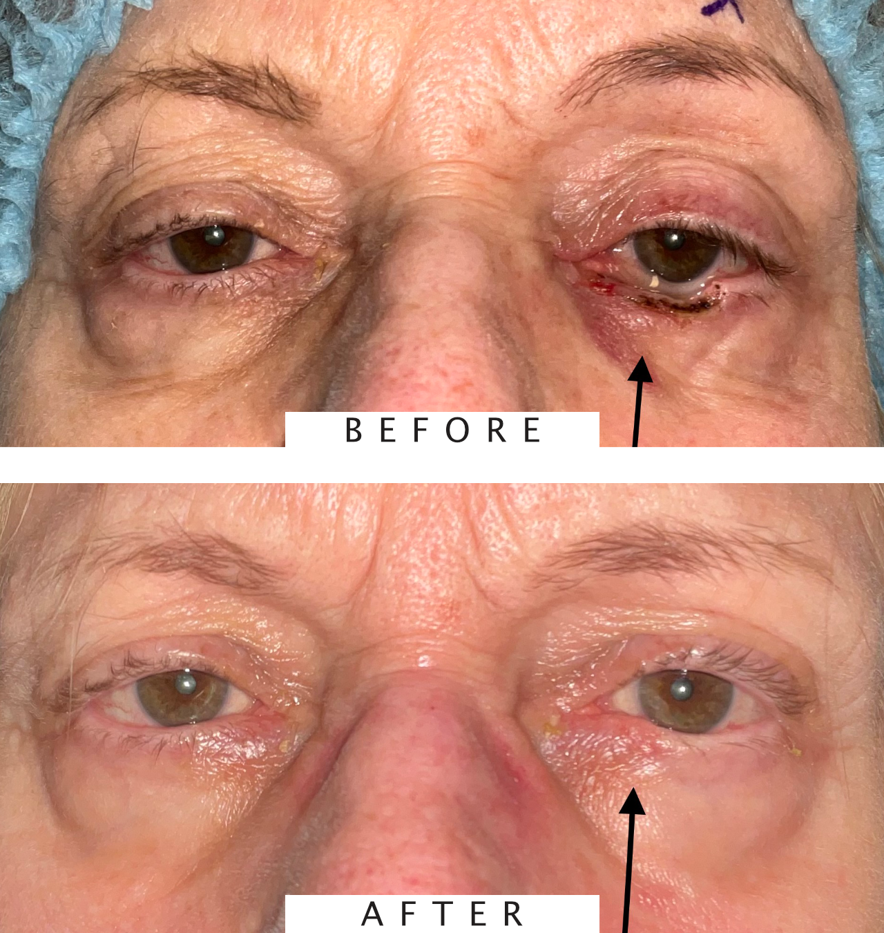 Mohs Surgery for Skin Cancer Reconstruction of Eyelid