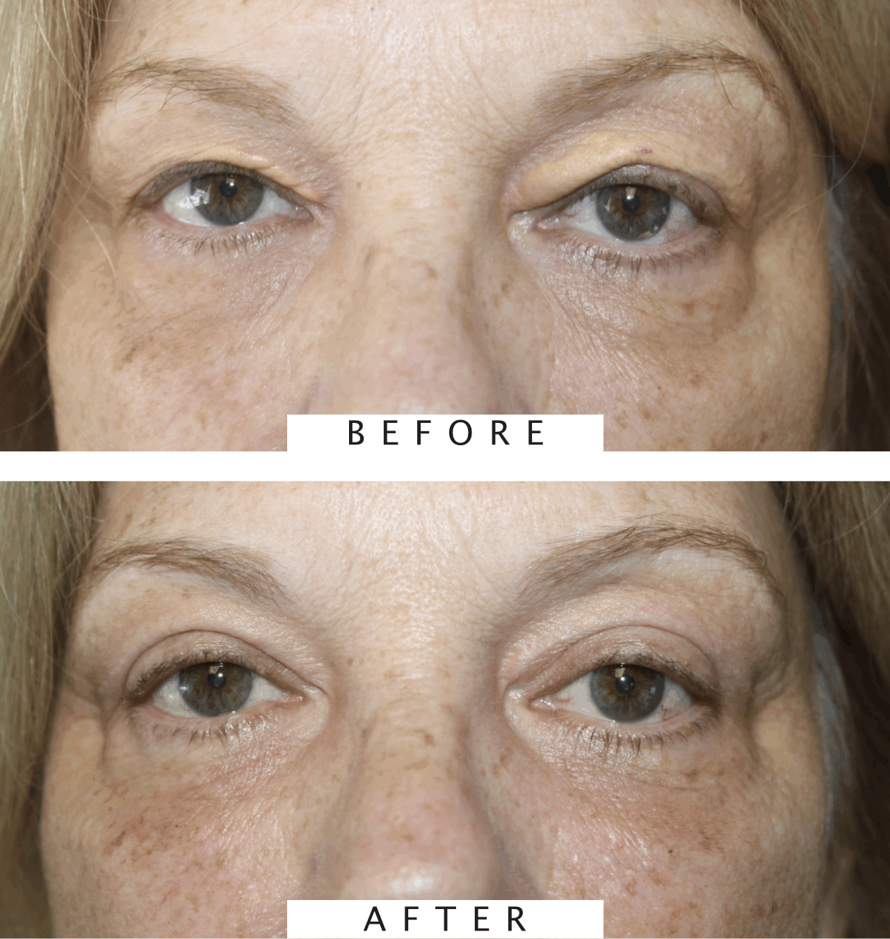 Xanthelasma Excision and Reconstruction