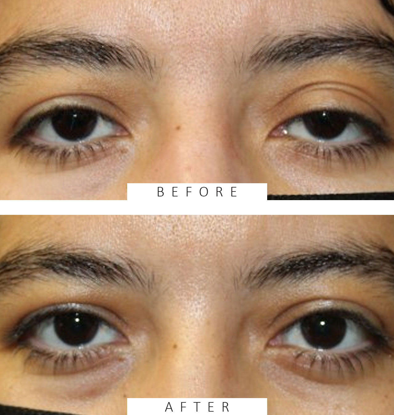 Internal Ptosis repair on Left Side.