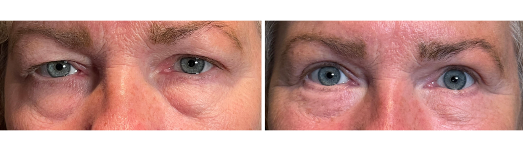 Almallah - Blepharoplasty Upper and Lower Lids