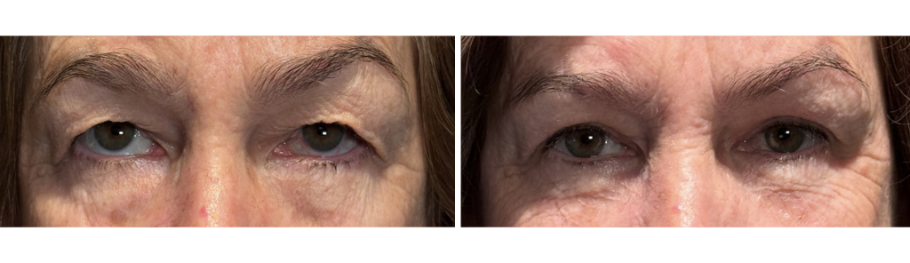 Almallah - Cosmetic Blepharoplasty