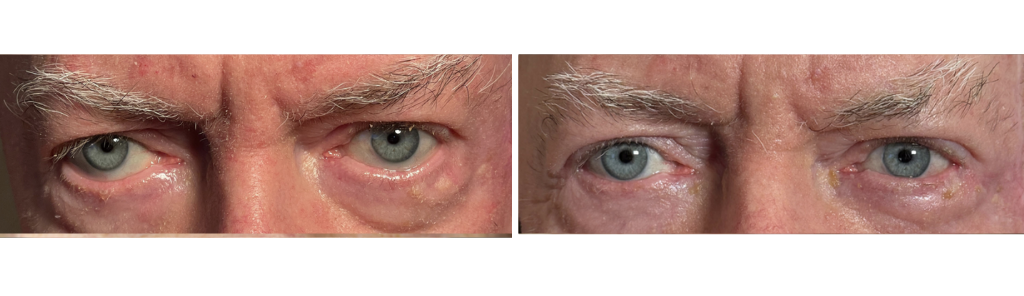 Almallah - Eyelid Repair Procedure - 1