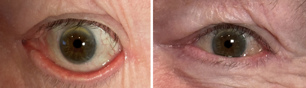 Almallah - Eyelid Repair Procedure - 2