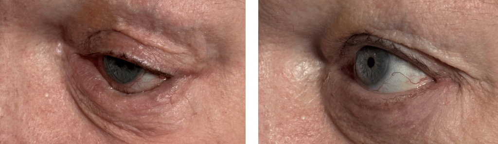 Almallah - Eyelid Repair Procedure - 3