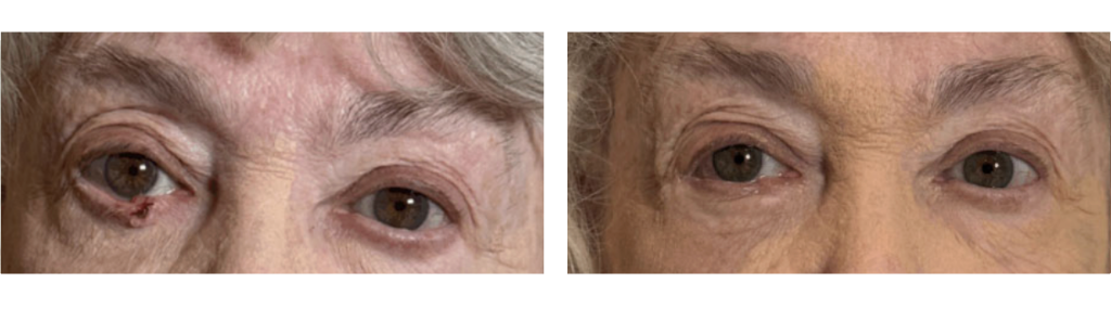 Almallah - Skin Cancer - 1