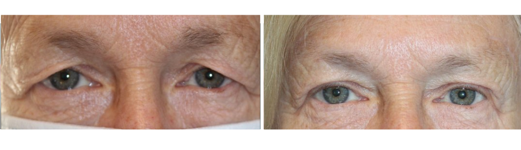Baha - BrowLift - 1