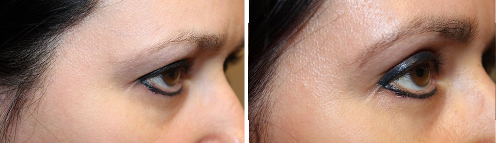 Baha - BrowLift - 2
