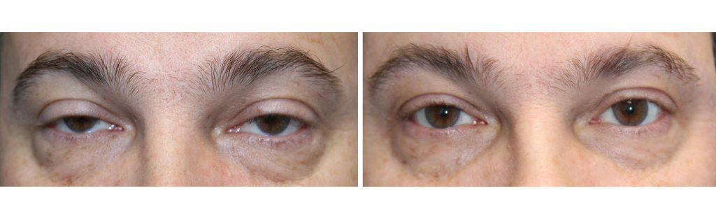 Baha - Ptosis Repair - 1