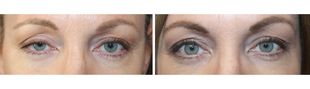 Baha - Ptosis Repair - 2