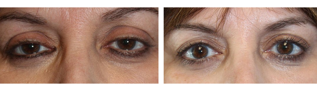 Baha - Ptosis Repair - 4