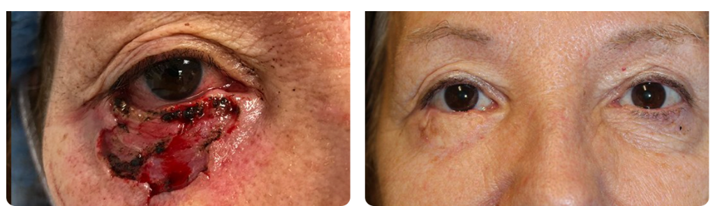 Baha - Skin Cancer - 2