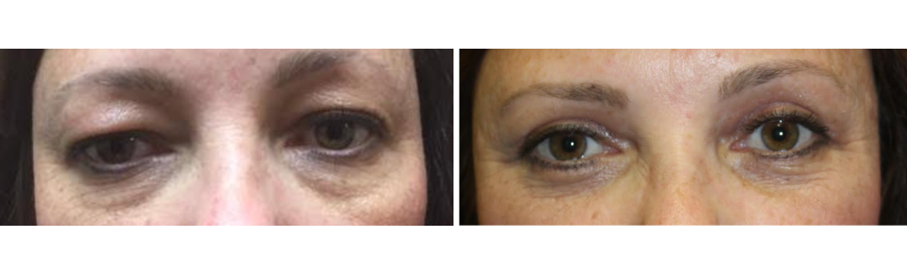 Baharestani - blepharoplasty 1