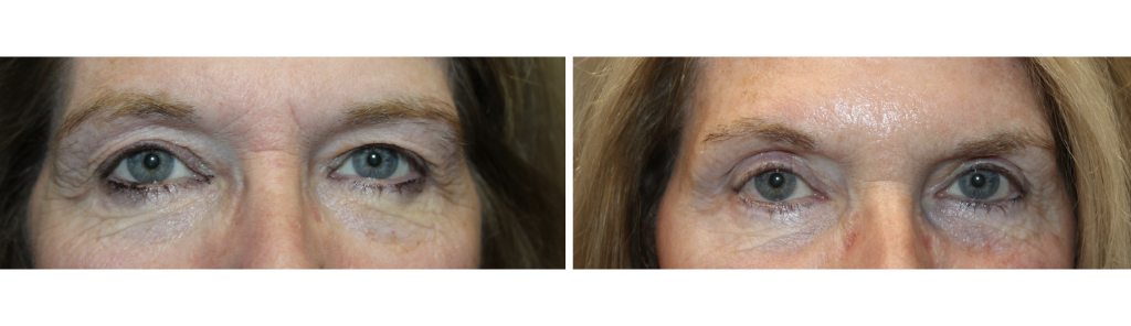 Baharestani - blepharoplasty 2