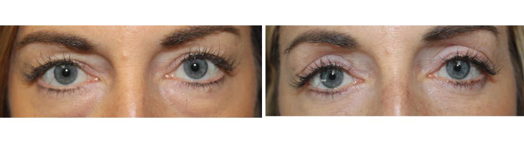 Baharestani - blepharoplasty 3