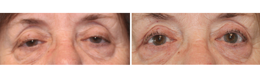 MILEO - Ptosis Repair - 1