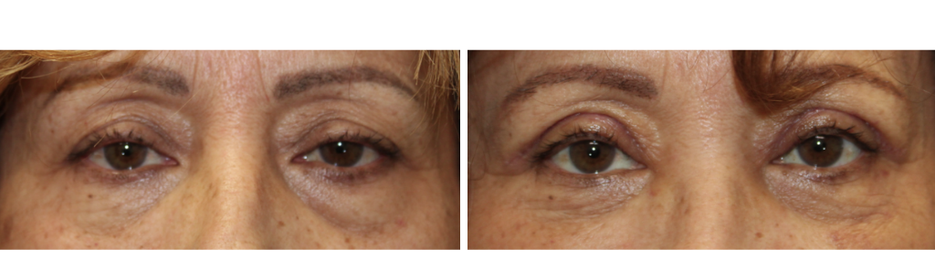 MILEO - Ptosis Repair - 2