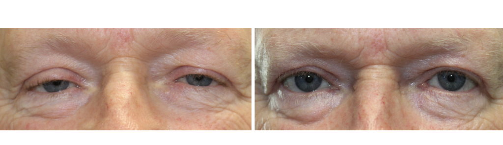 MILEO - Ptosis Repair - 3
