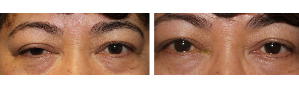 MILEO - Ptosis Repair - 4
