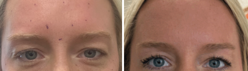 Mileo - Botox - 1