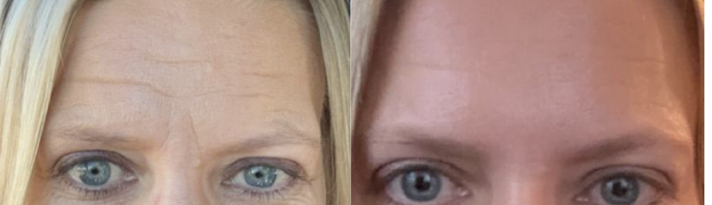 Mileo - Botox - 2