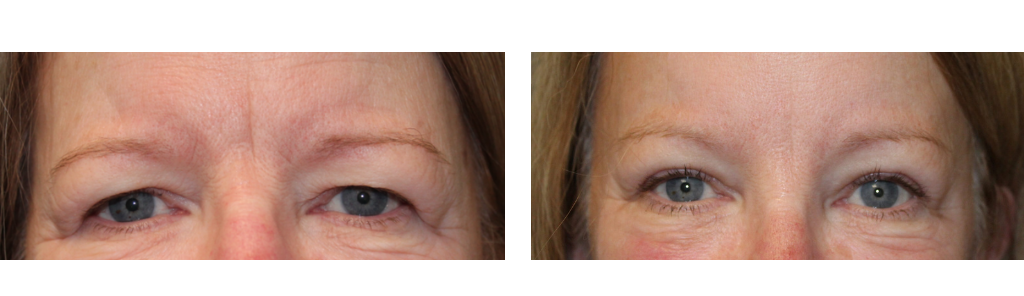 Mileo - BrowLift - 1