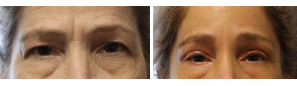 Mileo - BrowLift - 2