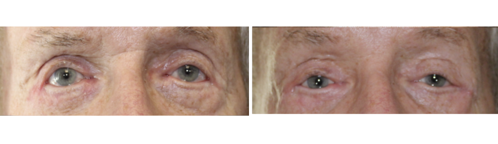 Mileo - Eyelid Repair Procedure - 1