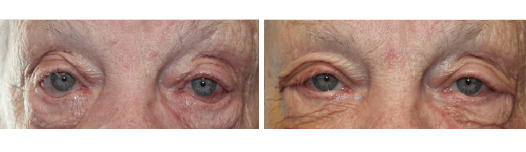Mileo - Eyelid Repair Procedure - 2